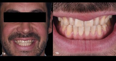 An aesthetic, minimally invasive restoration using a fully digital workflow