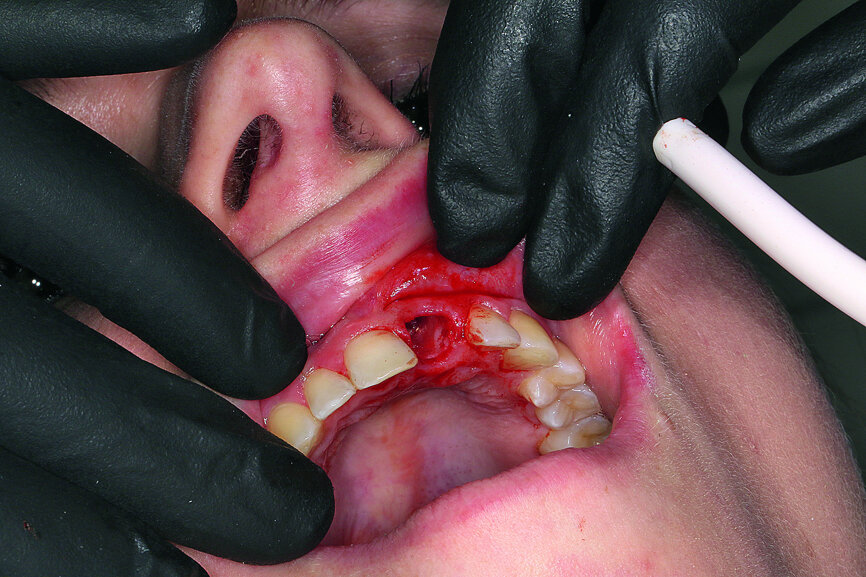 Fig. 7: Gentle extraction preserving the vestibular lamina.