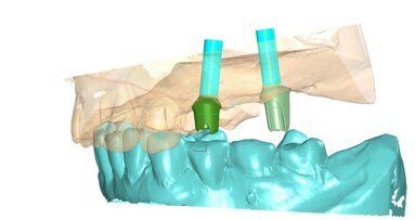 Protesi parziale fissa supportata da impianti nella riabilitazione di edentulie parziali multiple. Il posizionamento implantare “protesicamente guidato”.