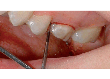 El uso del láser en el tratamiento periodontal