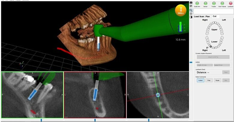 Dental News - Neocis reaches first commercial milestone for Yomi ...