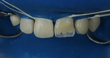 Polychromatic Layering Technique (PLT)—full protocol: a case report