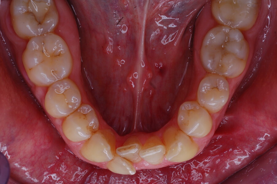 Fig. 37–44: Sequential intra-oral photographs illustrating progressive alignment of the mandibular arch.