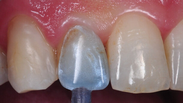 Restauration de dents antérieures « à emporter »