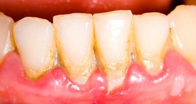新たな研究により、慢性歯周炎と脳卒中に強い関係性があることが判明