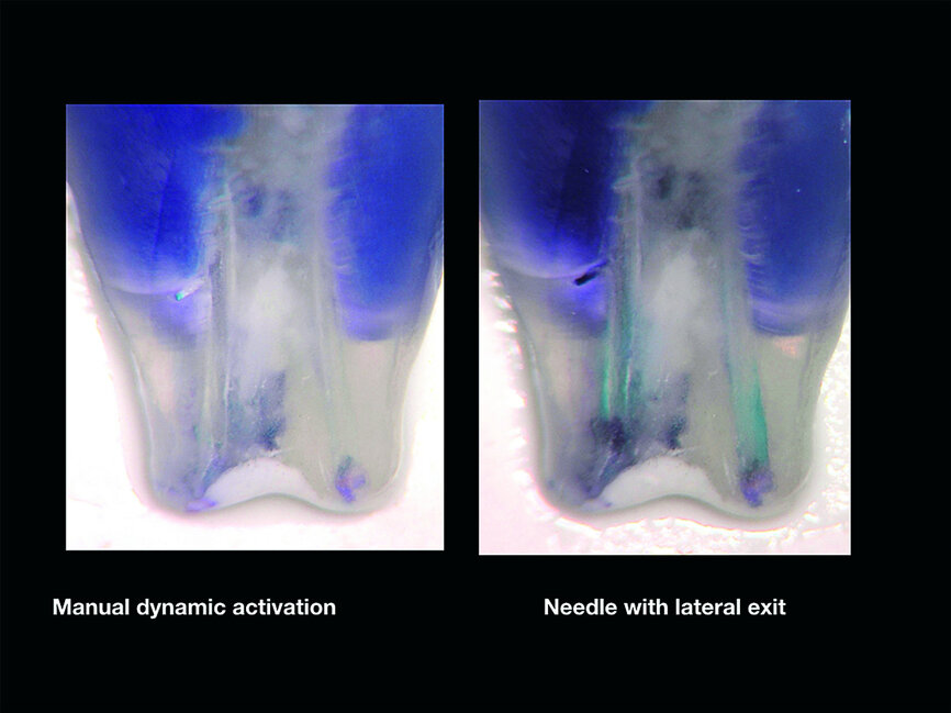 Fig. 2b: Sleiman-Iandolo testing.
Results of the dye removal with
manual dynamic activation (left) and
side-vented needle (right).
Note the poor results of the cleaning.