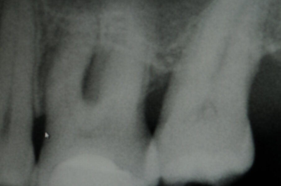 Fig. 5j - Radiografia a 6 mesi.
