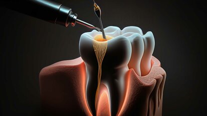 Revolutionäre Endodontie: Die Macht der Digitalen Geführten Therapie