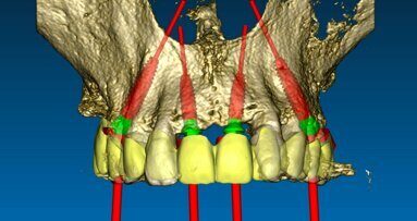 Il flusso digitale nelle riabilitazioni implanto-protesiche in chirurgia guidata