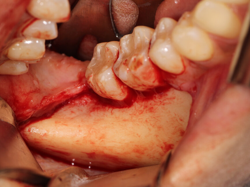 Fig. 6: A crestal incision is made with a sulcular incision to connect to the vertical releasing incision that was created then a full thickness flap is elevated to expose the lateral aspect of the mandibular body that will serve as the donor harvesting site.