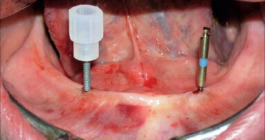 Stabilizace protézy v dolní čelisti – MDI Mini Dentální Implantáty