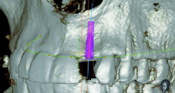 DT News - International - Aesthetics reimagined with INVERTA implant