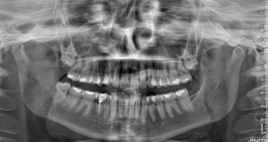 External cervical root resorption in anterior mandibular area: Diagnosis and treatment alternatives