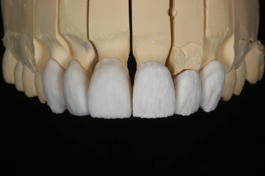 Fig. 12: A layer of luster porcelain applied to the minimally reduced restorations.