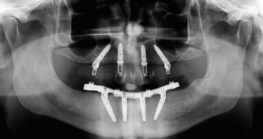 Three-year clinical and radiographic outcomes of patients treated according to the All-on-4 concept in the daily practice: A prospective observational study on implants and prosthesis survival rates and complications