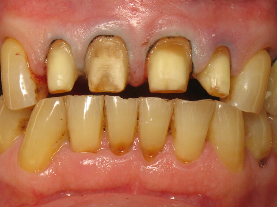 Fig. 8: Tooth preparation and retraction cord placement.