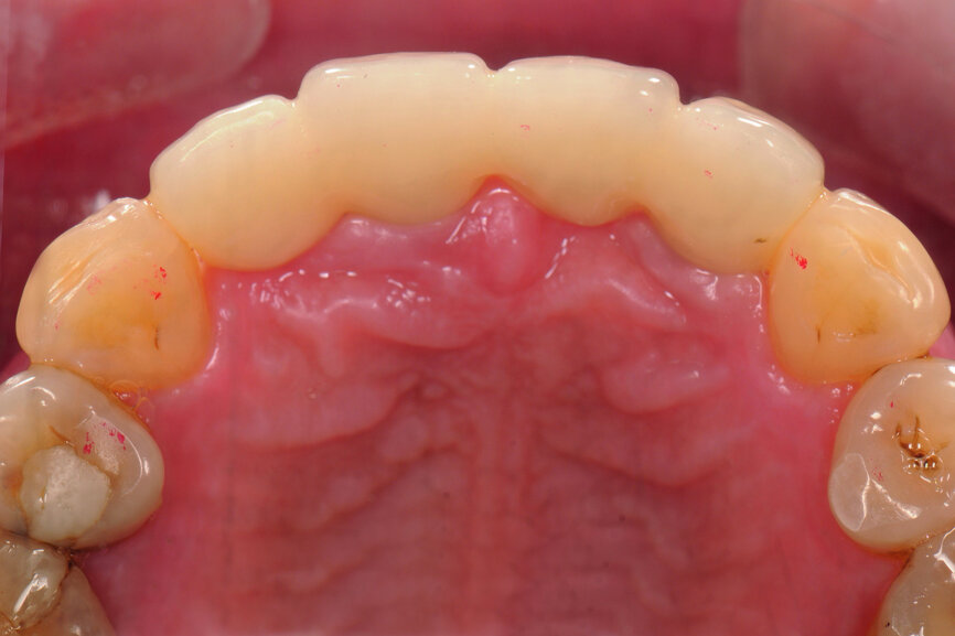Fig. 44: ICP occlusal contact (12 μm occluding paper, red).