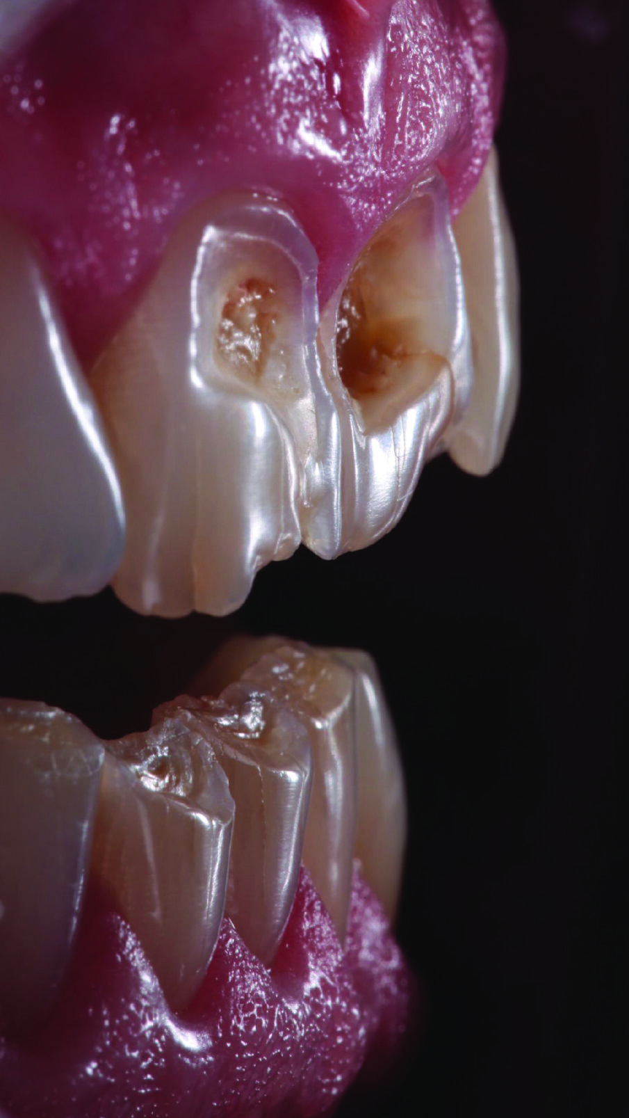 Lateral view of the anterior teeth revealed the depth of the lesions on the vestibular surfaces.