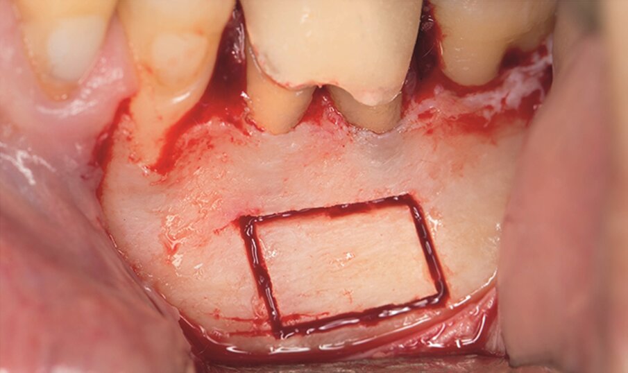 … with a saw mounted in a Piezotome CUBE LED handpiece, then the bone was cut and removed (g & h) …