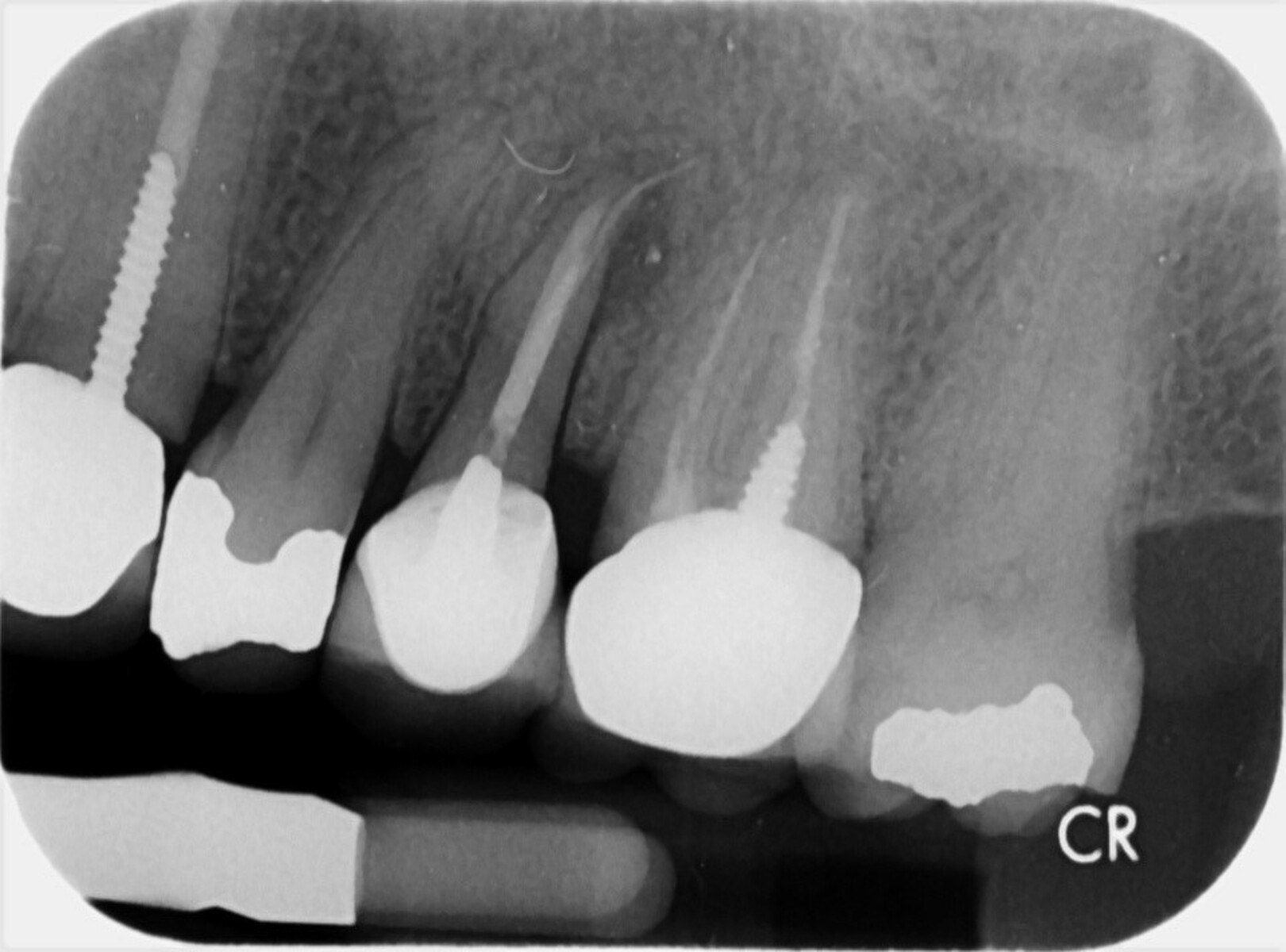 Buccal root of the bifurcated maxillary premolar—a danger zone during