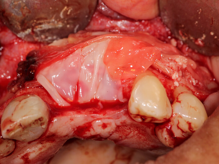 Fig. 13: A PRP membrane was placed over the grafted area prior to flap closure as a resorbable long term membrane to prevent soft tissue ingrowth as the osseous graft heals and matures.