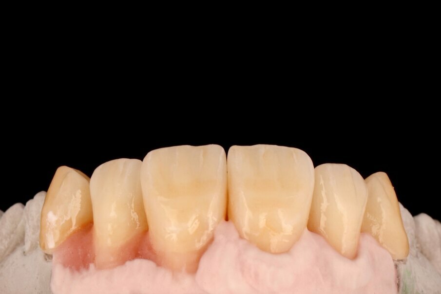 Fig. 26a: Multi-chromatic layering of gingival structures.