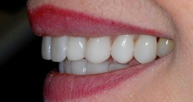 Licówki porcelanowe GlamSmile nakładane na zęby dolne i górne. Analiza kliniczna – Część 1