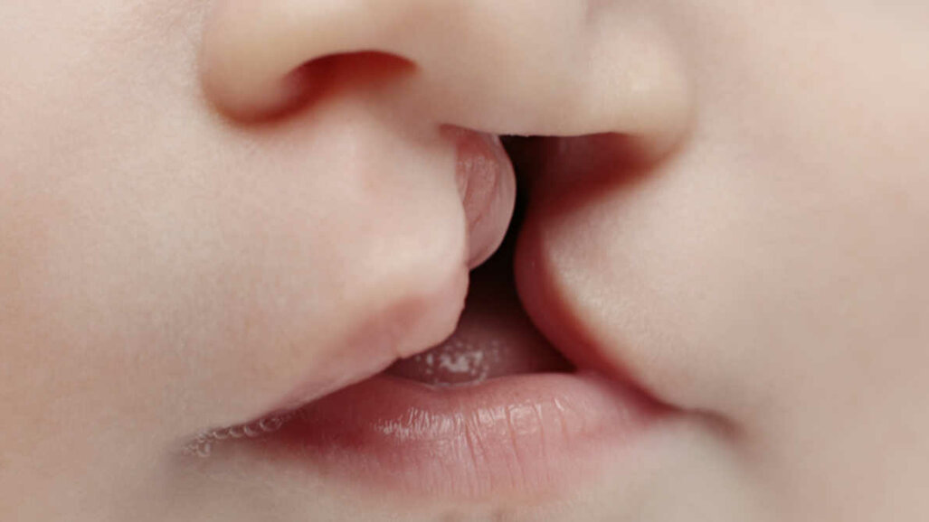 Pesquisadores descobrem mecanismo genético que desencadeia fissura de lábio e palato
