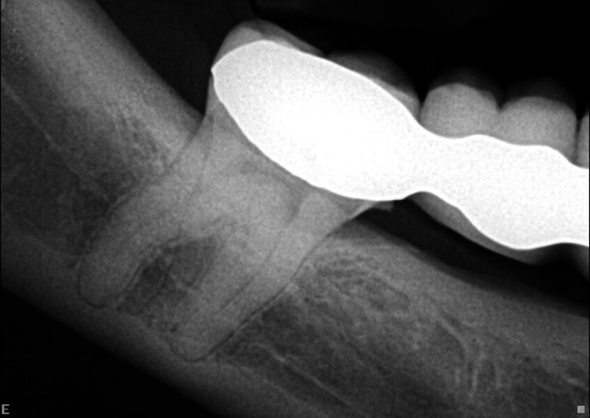 Fig. 12 : Radiographie préopératoire montrant la relation étroite entre le canal mandibulaire et la molaire. 