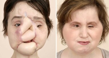 Succesvolle gezichtstransplantatie bij jonge vrouw