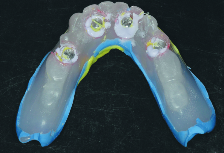 Fig. 6: Completed final impression using the custom tray and light body and medium body PVS, as well as rigid bite registration material around the impression copings to eliminate any movement of the copings.