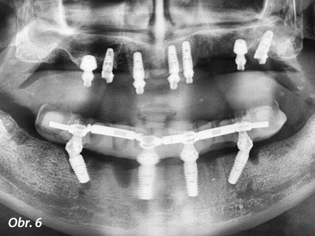 Panoramatický snímek zubů zachycující implantáty v dobré pozici. Ultrakrátké implantáty byly zavedeny v dobrém vztahu k čelistním dutinám, ale byly obklopeny malým množstvím kosti.