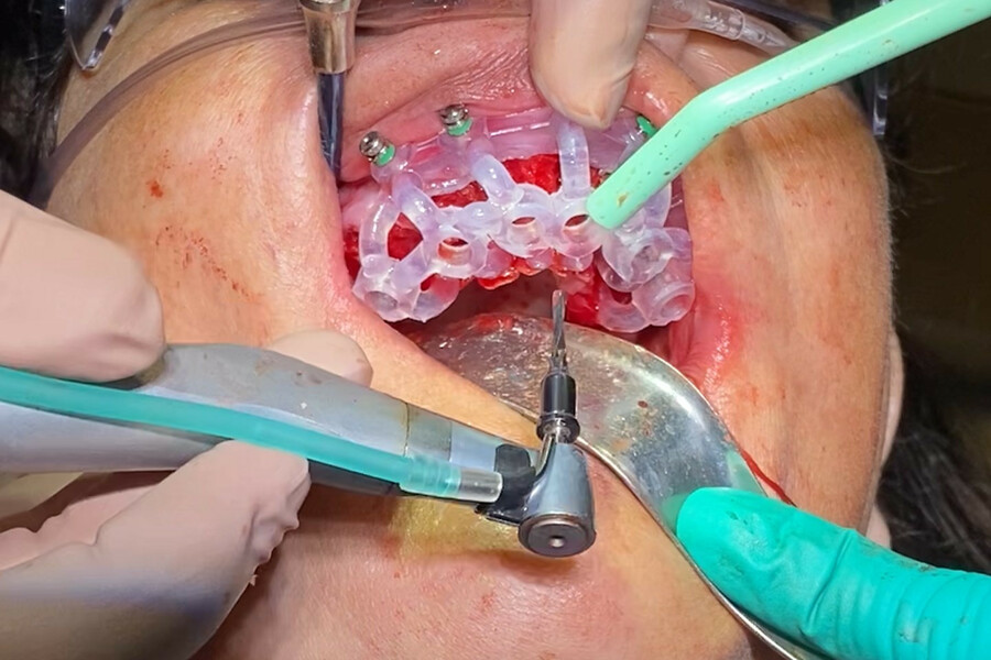 Fig. 16: Surgical guide fixated to the maxillary arch for guided drilling protocols.