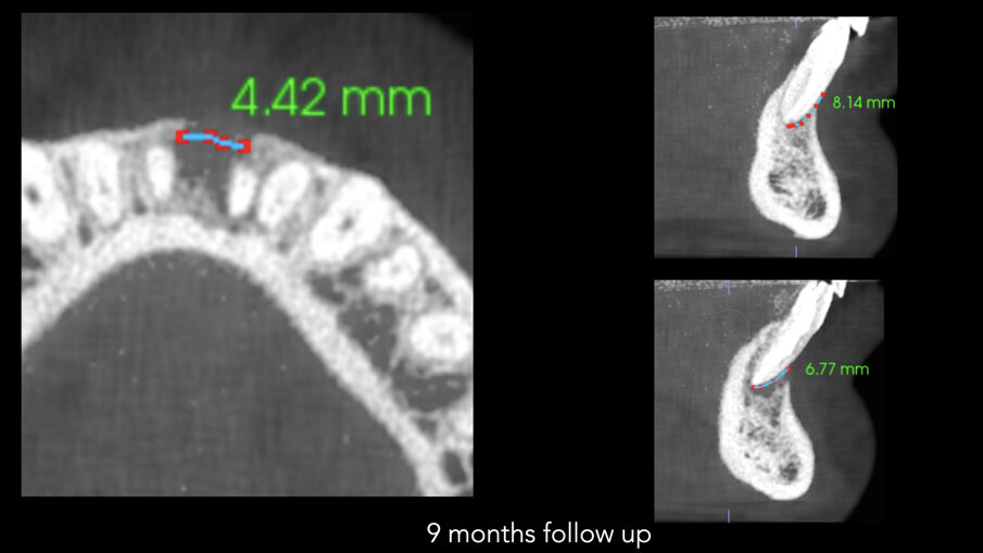 Slike 6a–c: Horizontalni pogled na i-CAT skeniranje snimljeno na kontroli nakon devet meseci koja pokazuje defekt kosti od samo 4,42 mm (a). Vertikalni pogledi na oba centralna sekutića pokazuju zarastanje kosti ispod vrhova i kost koja raste vertikalno na bukalnom aspektu (b & c)