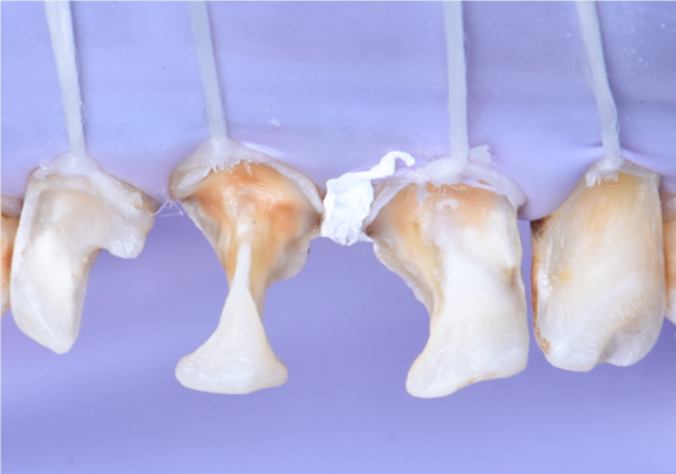Step 3 – Cavity preparation   Caries excavation and final cavity preparation with bevel was prepared.