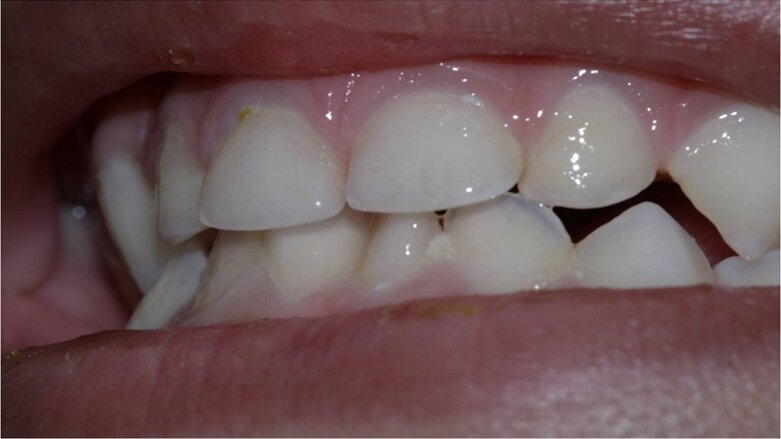 Treating Incipient Dental Caries In Children, A New Method Developed