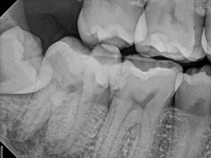 Fig. 15b: Cased treated with PIPs (Photon Induced Photoacoustic Streaming). Note the orifice barrier placed in composite to protect the endodontic treatment from coronal leakage. (Courtesy of Dr. Paula Elmi)