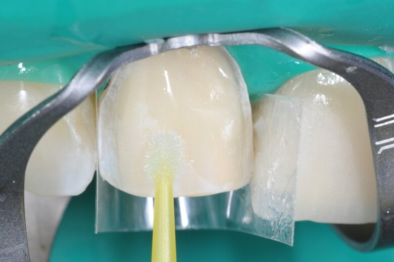 Fig. 15 Treatment with the self-etching primer PANAVIA V5 Tooth Primer (left on for 20 seconds).