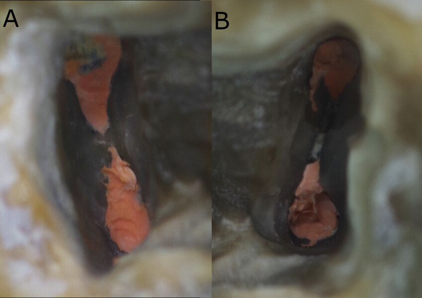 Figs. 6a & b: Gutta-percha cut by 1–2 mm inside each root canal with an ultrasonic tip and manual excavators.