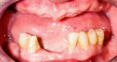 Izguba zob je lahko povezana z nižjo kognitivno funkcijo