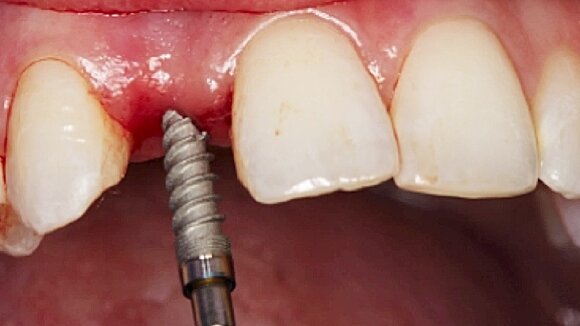 Optimising lateral incisor function and aesthetics with the Hahn Tapered Implant System
