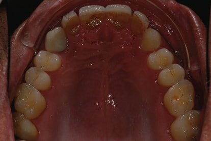 Fig. 2: Intraoral photograph prior to treatment, occlusal view of maxilla.