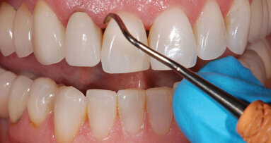 The Truth About Crowns & Bridges Which All Dentists Should Know