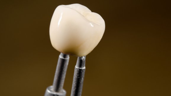 Investigan el desgaste de las coronas cerámicas en los dientes primarios