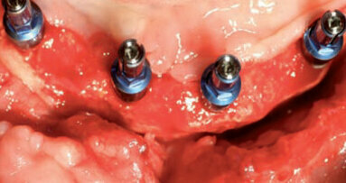 Reconstruction 3D de la crête alvéolaire chez un patient présentant une perte osseuse importante