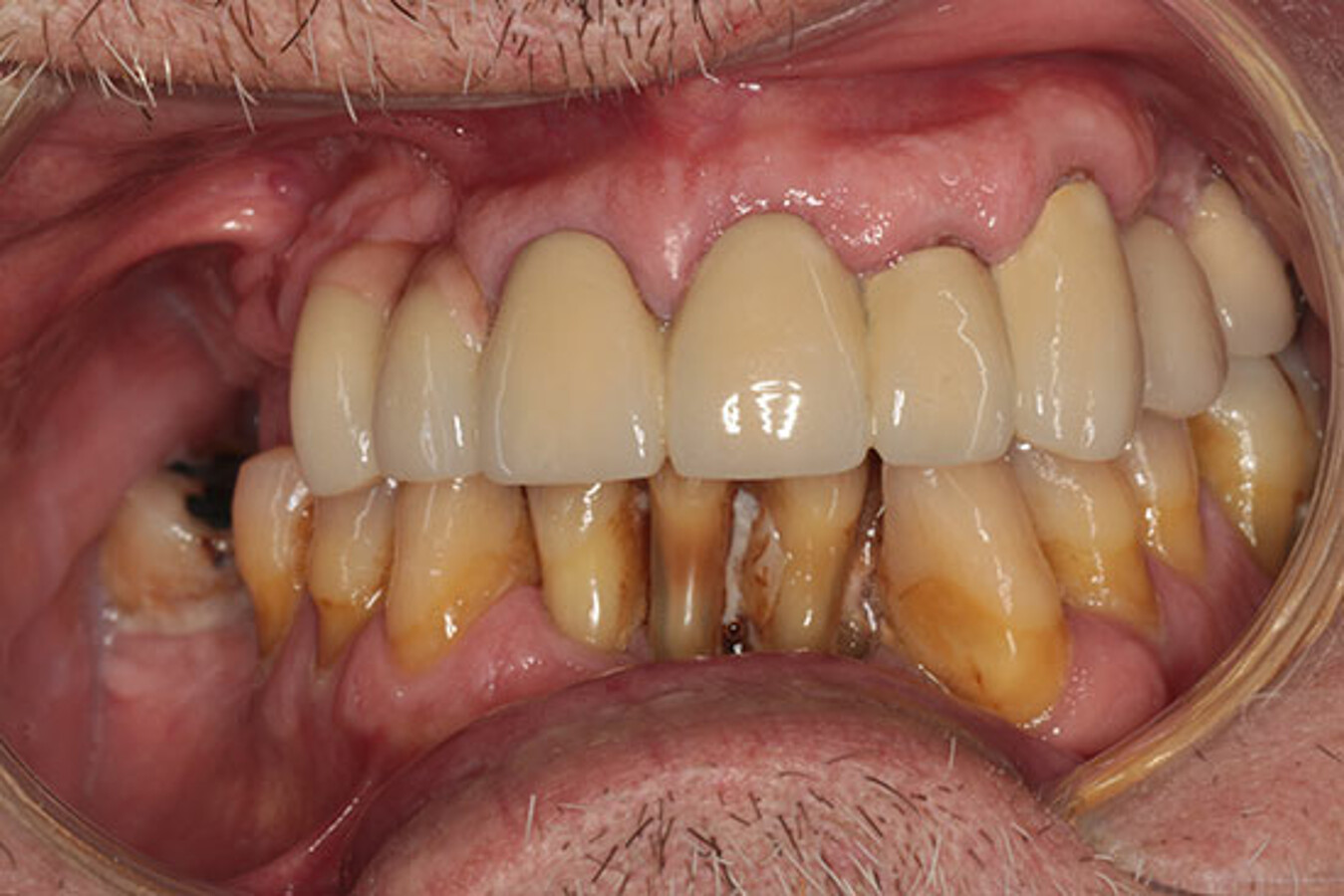Fig. 1. Imagen frontal preoperatoria. Enfermedad periodontal avanzada y ausencias dentales en primer y segundo cuadrante compensadas mediante voladizos protÃ©sicos. 