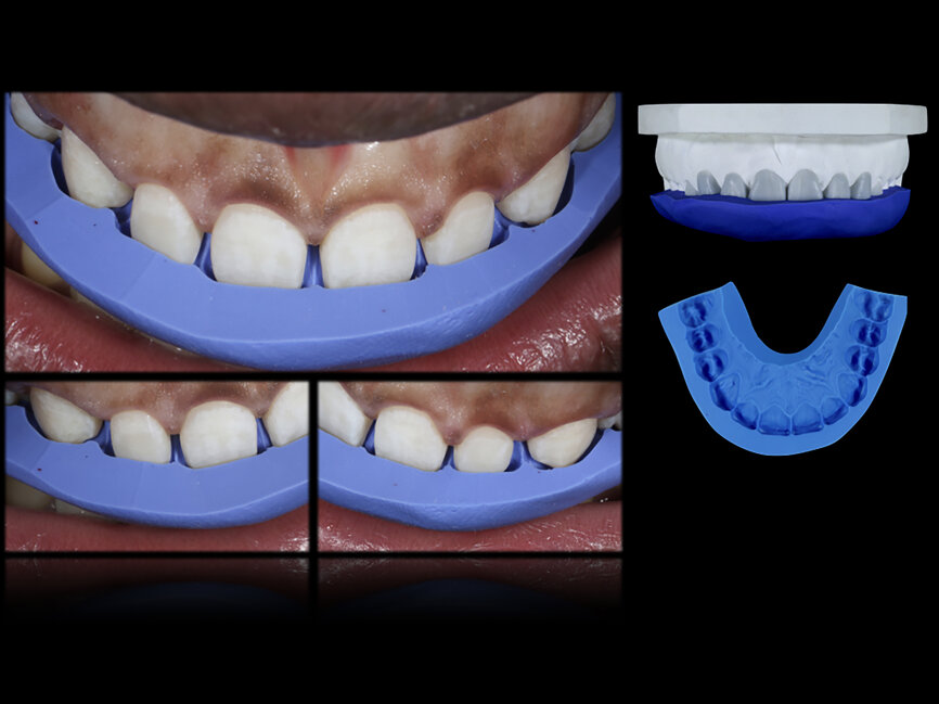 Fig. 55: Silicone index used to check incisal-facial reduction.