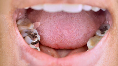 BDA Northern Ireland labels dental amalgam phase-out “unworkable”
