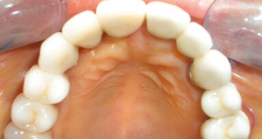 Operatività odontoiatrica o di chirurgia maxillo-facciale nel paziente epatopatico