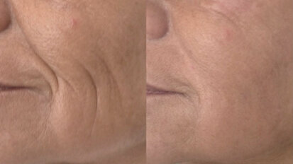 Ringiovanimento del viso con tecnica intraorale grazie al laser Fotona Er:YAG 2940 nm SMOOTH Mode